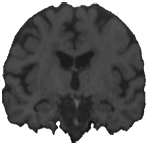 MRI coronal slice