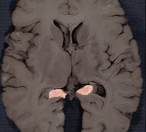 a coronal view of the hippocampus 