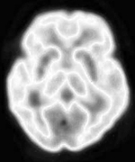 Positron Emission Tomography scan